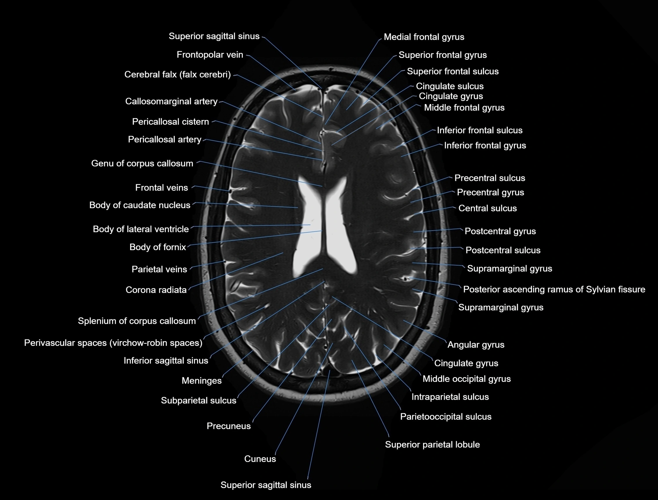 MRI Brain axial cross sectional radiology anatomy 3T image  -img-00001-00036.webp